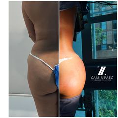 Gluteoplastia - Dr. Zamir Páez