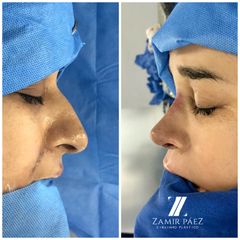 Rinoplastia - Dr. Zamir Páez