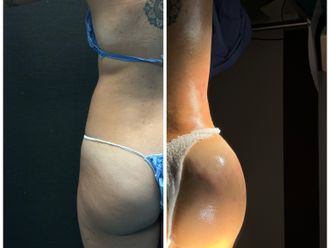 Gluteoplastia antes y después - 870414