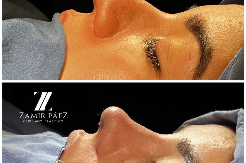 Rinoplastia antes y después - 870418
