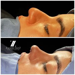 Rinoplastia - Dr. Zamir Páez