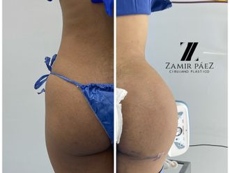 Gluteoplastia antes y después - 870420