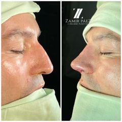 Rinoplastia - Dr. Zamir Páez