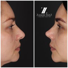 Rinoplastia - Dr. Zamir Páez