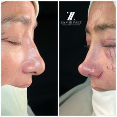 Rinoplastia - Dr. Zamir Páez