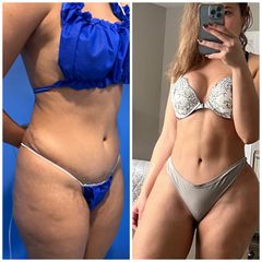 Abdominoplastia - Dr. Zamir Páez