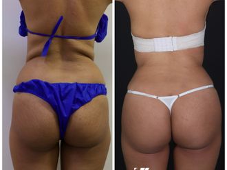 Gluteoplastia antes y después - 870429