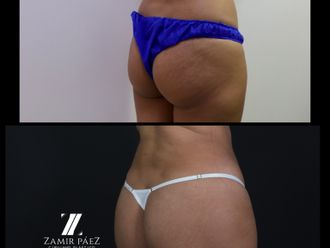 Gluteoplastia antes y después - 870430