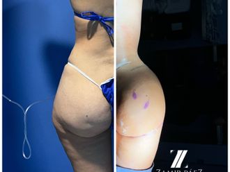 Gluteoplastia antes y después - 870431