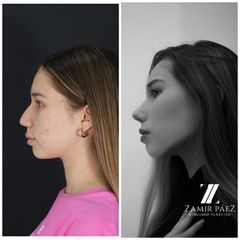 Rinoplastia - Dr. Zamir Páez