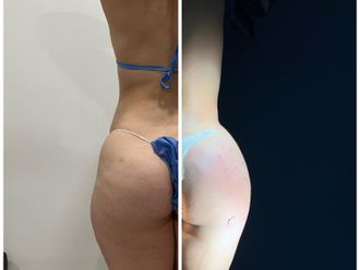 Gluteoplastia antes y después - 870433