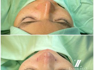 Rinoplastia antes y después - 870435