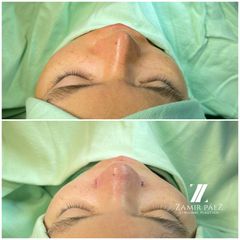 Rinoplastia - Dr. Zamir Páez