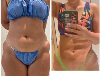 Abdominoplastia antes y después - 870436