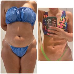 Abdominoplastia - Dr. Zamir Páez