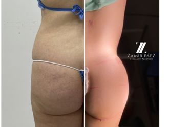 Gluteoplastia antes y después - 870439