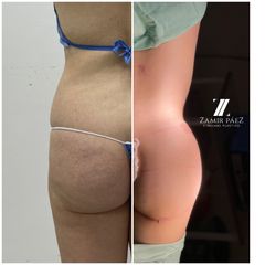 Gluteoplastia - Dr. Zamir Páez