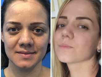 Rinoplastia antes y después - 870441