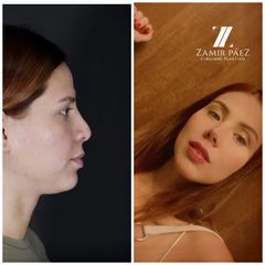 Rinoplastia - Dr. Zamir Páez