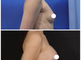 Mamoplastia de aumento antes y después - 870447