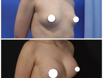 Mamoplastia de aumento antes y después - 870448