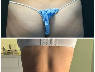 Gluteoplastia antes y después - 870449