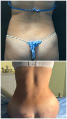 Gluteoplastia - Dr. Zamir Páez