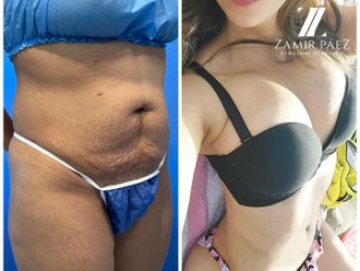 Abdominoplastia antes y después - 870450