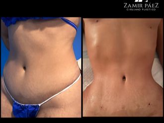 Abdominoplastia antes y después - 870451