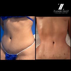 Abdominoplastia - Dr. Zamir Páez