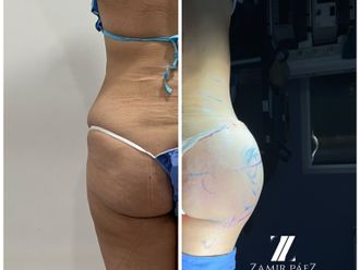 Gluteoplastia antes y después - 870452