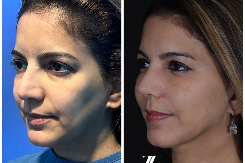 Rinoplastia antes y después - 870454
