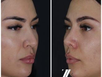 Rinoplastia antes y después - 870455