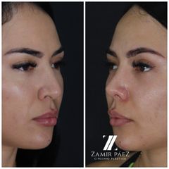 Rinoplastia - Dr. Zamir Páez