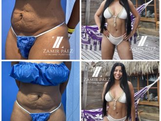 Abdominoplastia antes y después - 870456