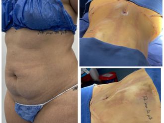 Abdominoplastia antes y después - 870458