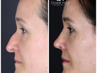 Rinoplastia antes y después - 870459