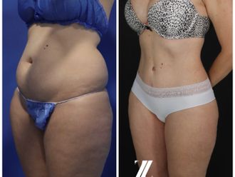 Abdominoplastia antes y después - 870463