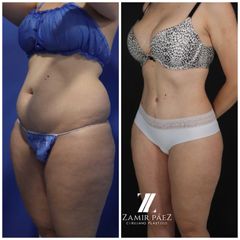 Abdominoplastia - Dr. Zamir Páez