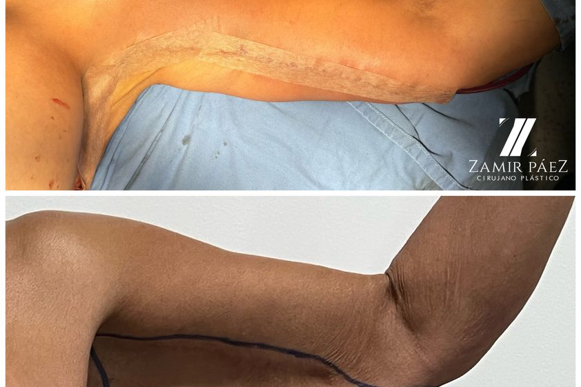 Liposucción antes y después - 870465