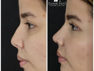 Rinoplastia antes y después - 870466