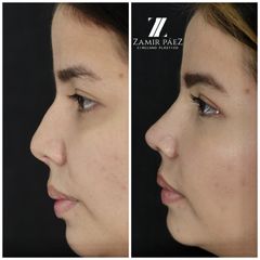 Rinoplastia - Dr. Zamir Páez