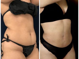 Abdominoplastia antes y después - 870467