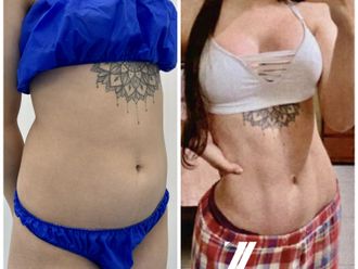 Abdominoplastia antes y después - 870470