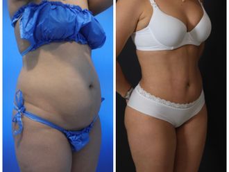 Abdominoplastia antes y después - 870471