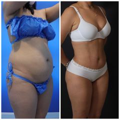 Abdominoplastia - Dr. Zamir Páez