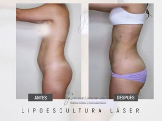 Lipoescultura