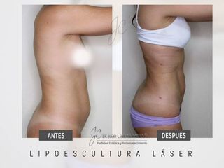 Lipoescultura