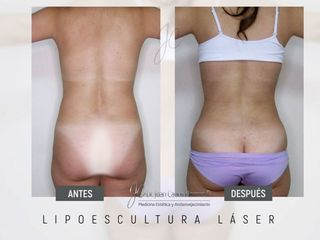 Lipoescultura