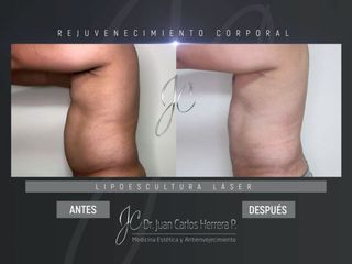 Lipoescultura